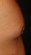 male nipple after reduction surgery